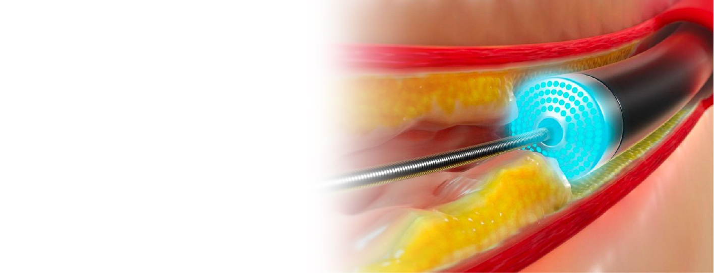 A Guide to Laser Angioplasty: Types, Procedure, Benefits, and Risks