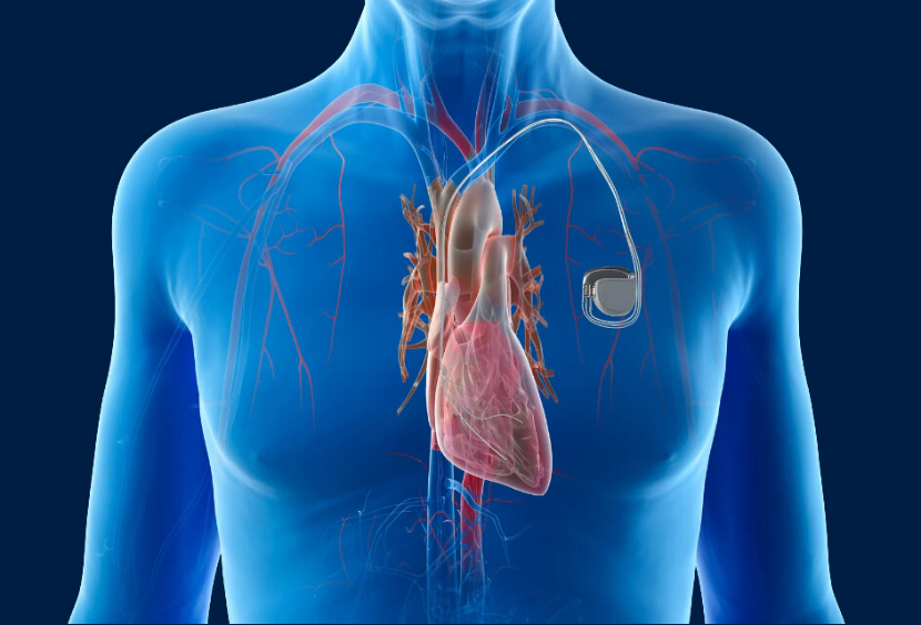 How Much Does Pacemaker Implantation Surgery Cost In Delhi, India?