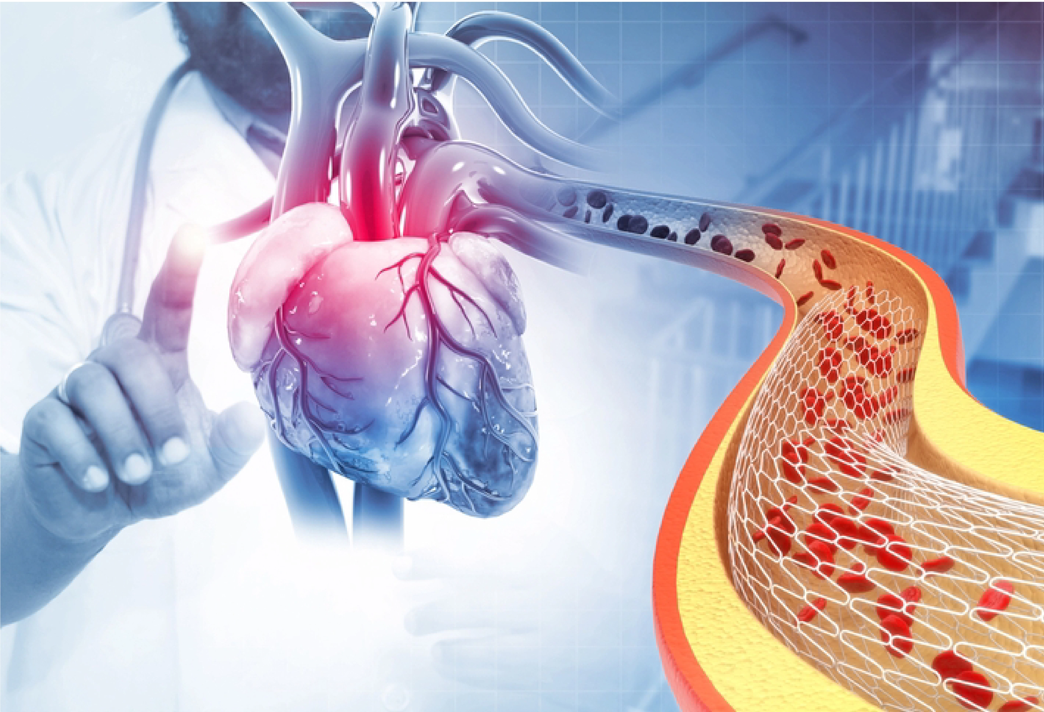 Angioplasty or Bypass: Which is Better?