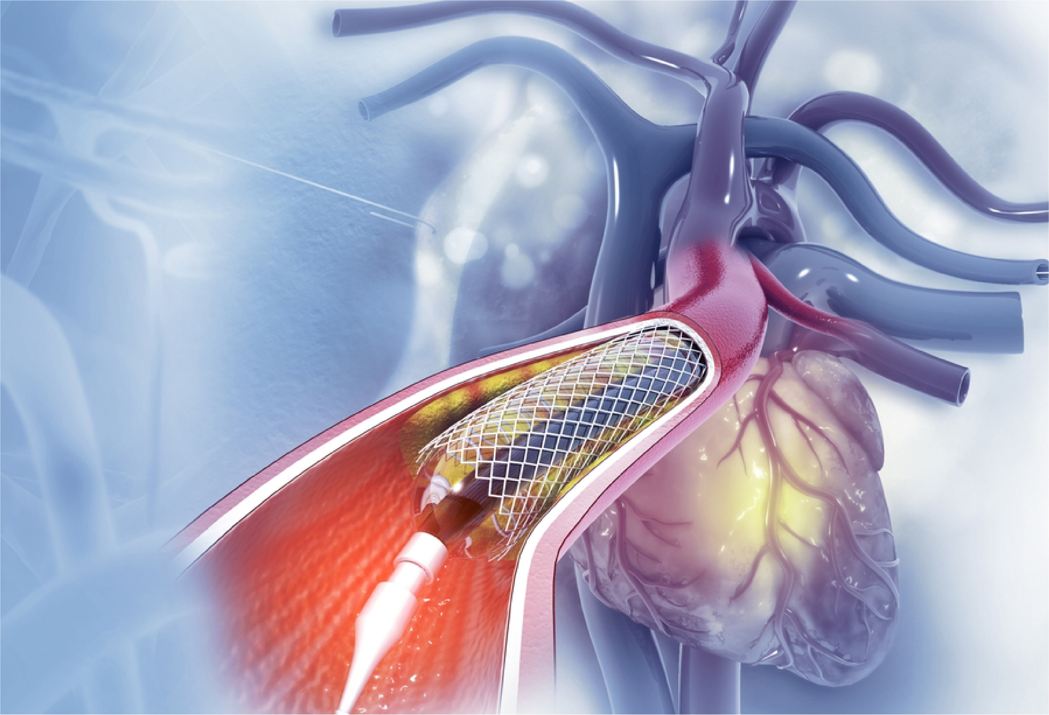 Heart Stent Procedure: A Step-by-Step Guide
