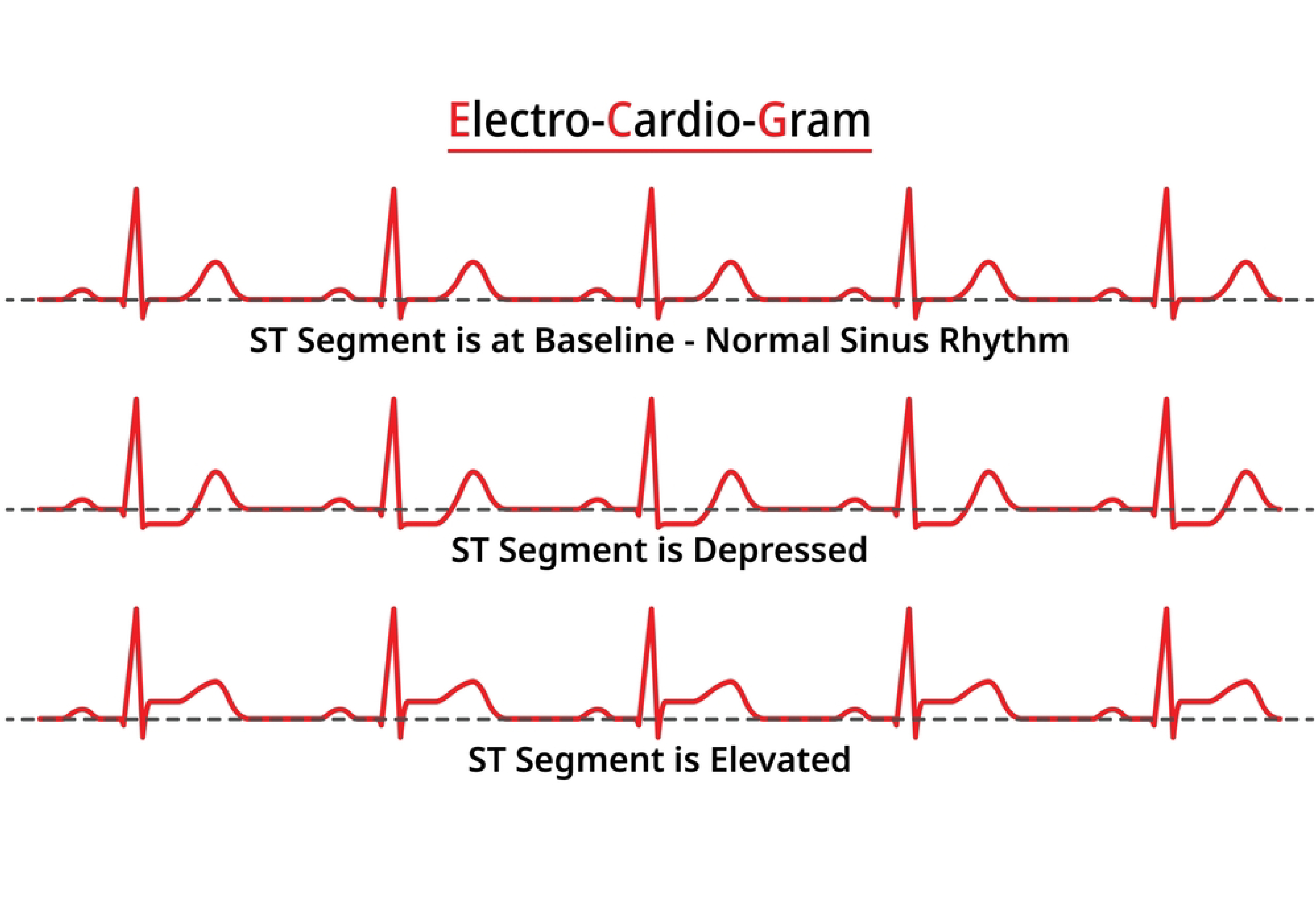Heart Attack ECG vs Normal ECG: How To Check ECG Report?