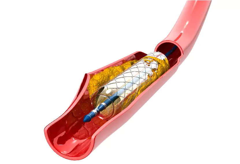 Angioplasty Price in India