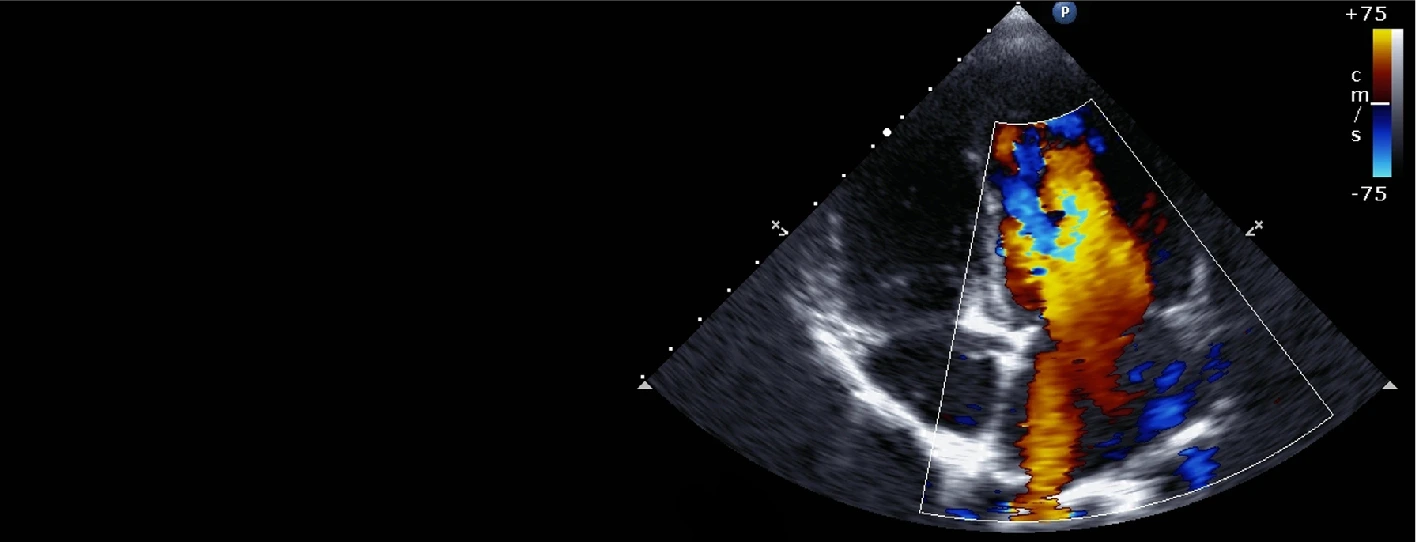Color Doppler Ultrasound in Chennai, India