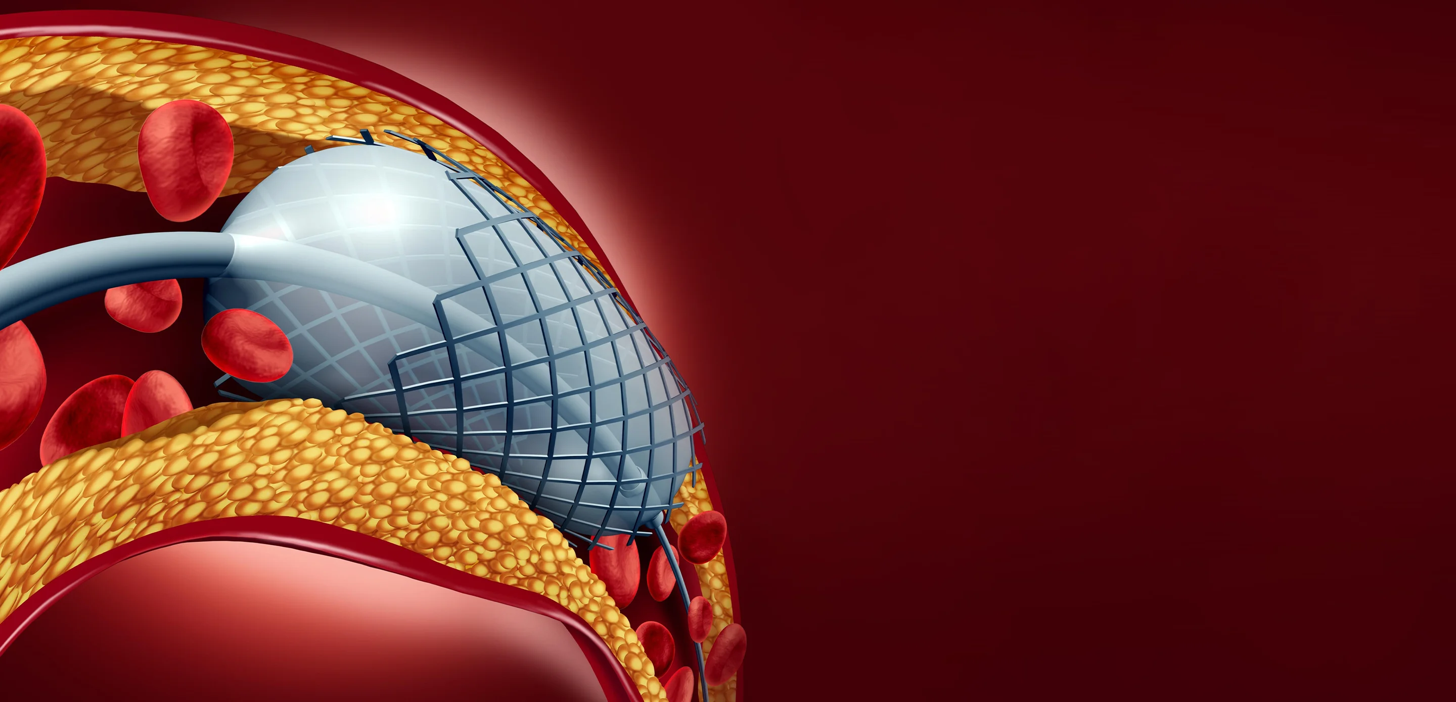 Interventional Cardiology